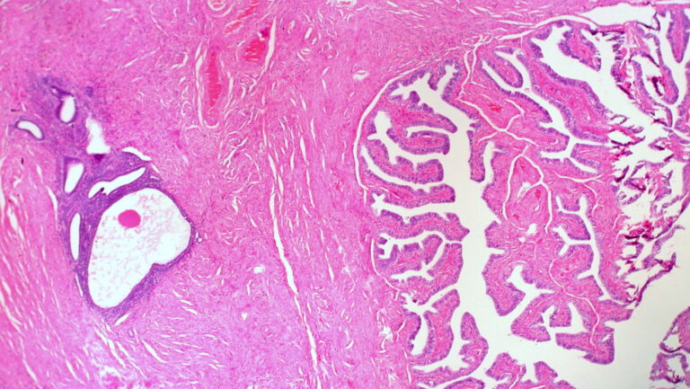 Oxford researchers trial non-invasive diagnostic scans for endometriosis